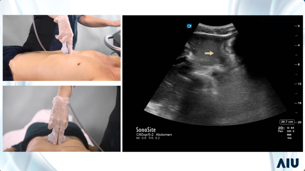 eFAST scan demonstration